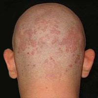seborrheic dermatitis dandruff
