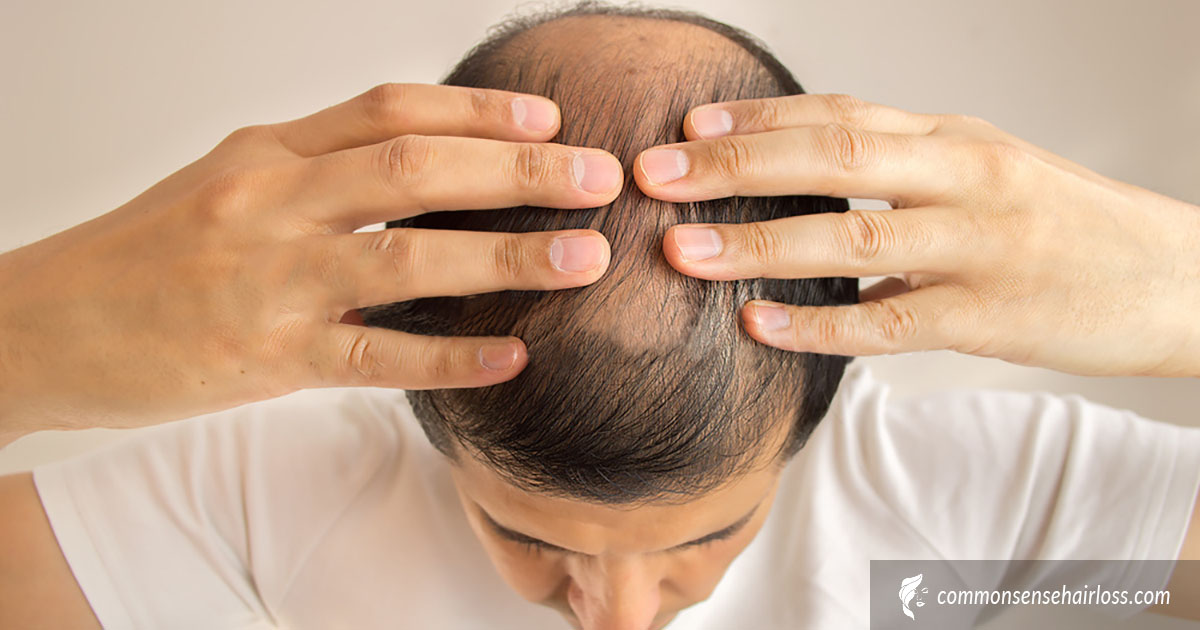 Scalp Exercises For Hair Loss | Common Sense Hair Loss