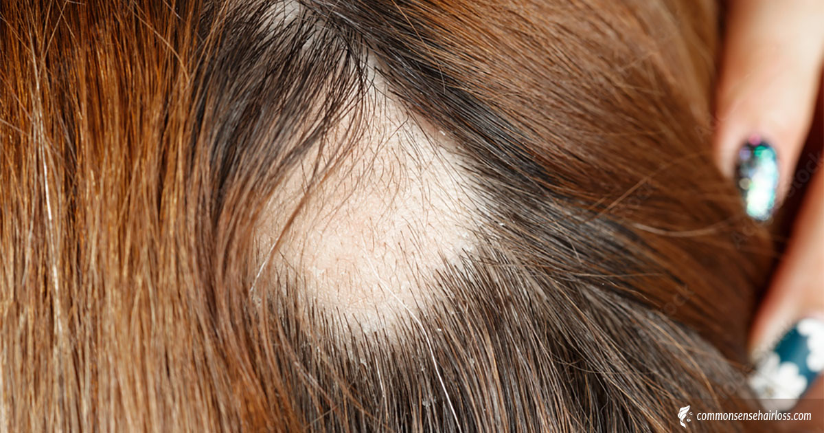 Female Pattern Baldness: Causes and Solutions