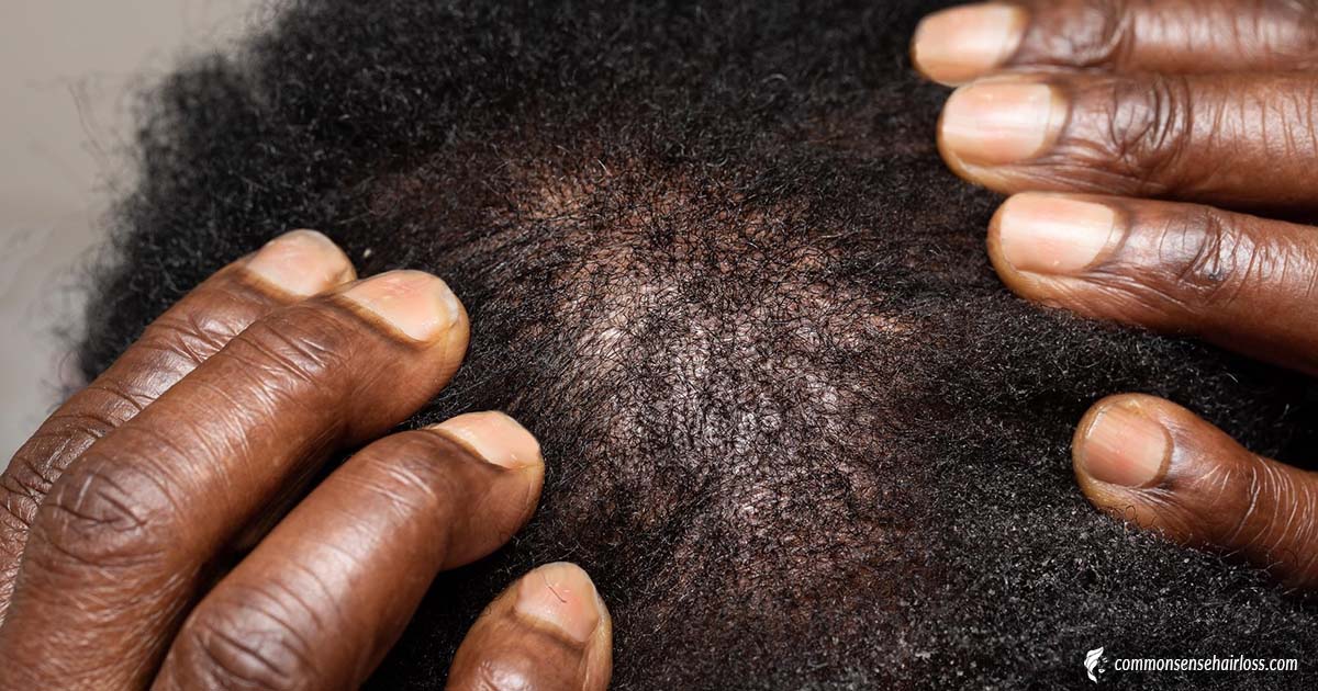 What To Do When You See These Early Signs Of Hair Loss