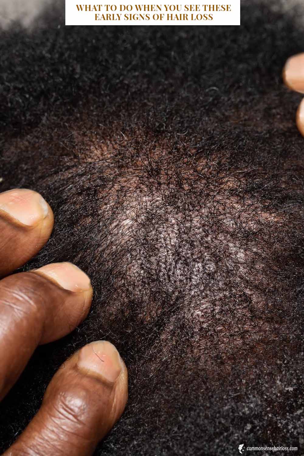 What To Do When You See These Early Signs Of Hair Loss